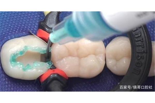 補牙用樹脂材料多久