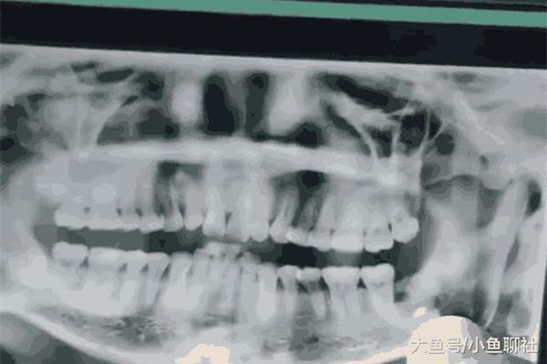 拔牙后多久消腫,拔牙后多久能完全愈合?