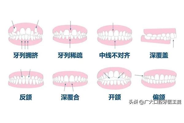 正畸時牙齒需要多長時間排列整齊,正畸后需要多長時間恢復穩定?