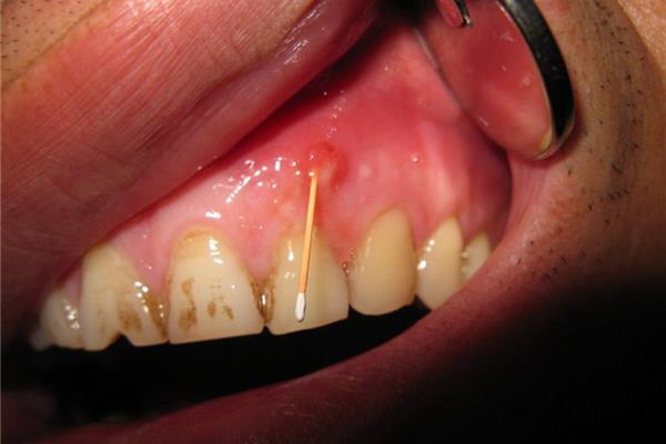 牙瘺治療 多久