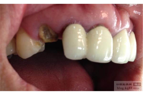 拔牙后可以做多長時間的臨時牙,拔牙后可以做多長時間的臨時義齒?