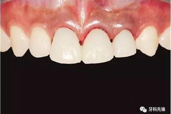后牙能種多久,后牙能拔多久?