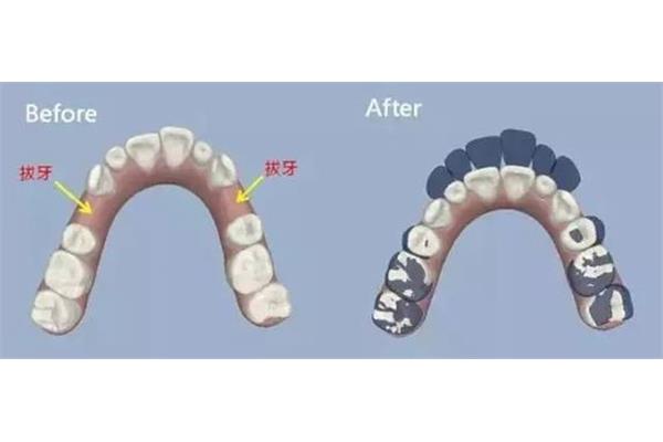 拔牙后多久可以做正畸?牙齒矯正的流程是怎樣的?