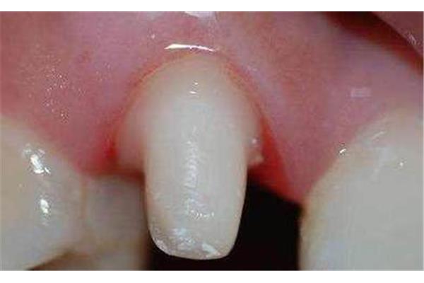 牙齒搭橋前后需要多長時間,固定橋牙一般能用多久?