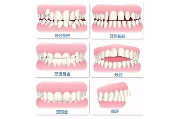 成年人矯正牙齒需要多長時間?牙齒矯正有哪些步驟?