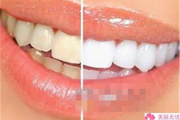 牙齒洗白可以保持多久