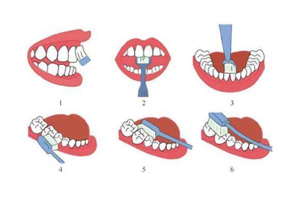 牙齒矯正需要多長時間?全頜手術后遺癥
