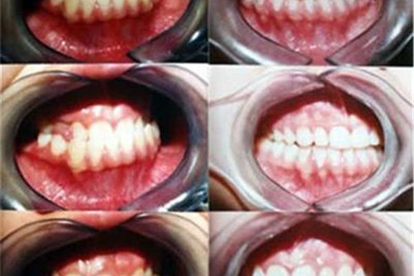 美冠矯正骨性齙牙,如何矯正兒童骨性齙牙?