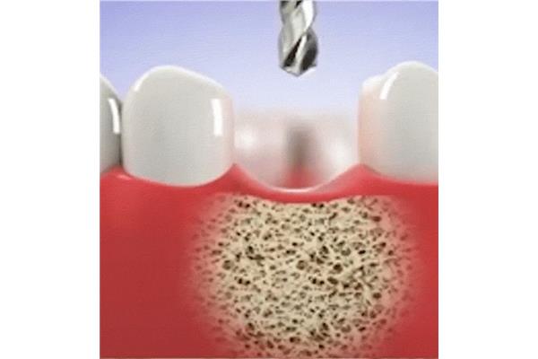 什么是仿生牙?你真的了解種植牙嗎?