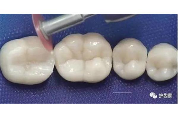 光固化樹脂補牙能用多久