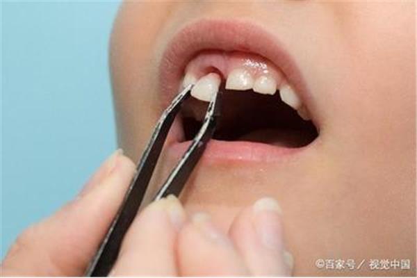 撥完牙能插多久,拔牙能插多久?