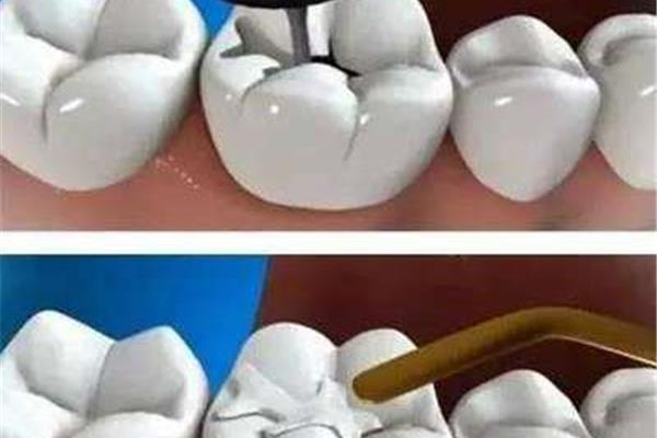 補牙材料可以保存多久