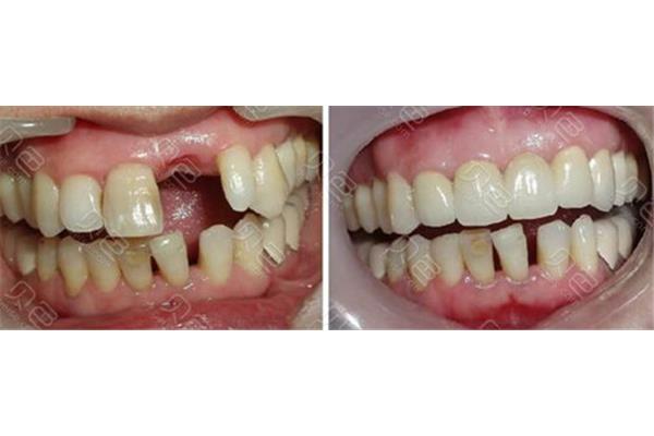 牙齒貼面一般能用多久,美白效果持續多久?