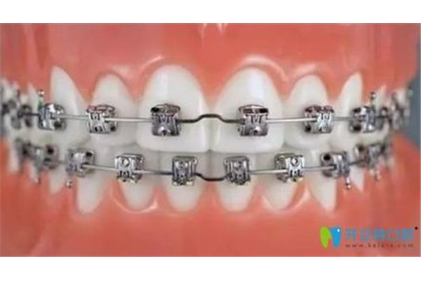 牙齒矯正需要多久才能看到效果?醫生需要多長時間才能戴上牙套?