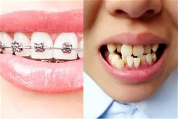 戴牙套需要多久,矯正牙齒需要多久?