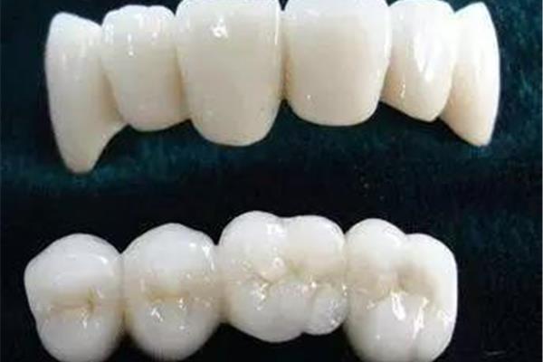 氧化鋯牙需要多長時間才適合,烤瓷牙的使用壽命有多長?