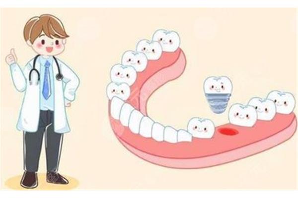 種植牙需要多久,種植牙與牙骨愈合需要多久?