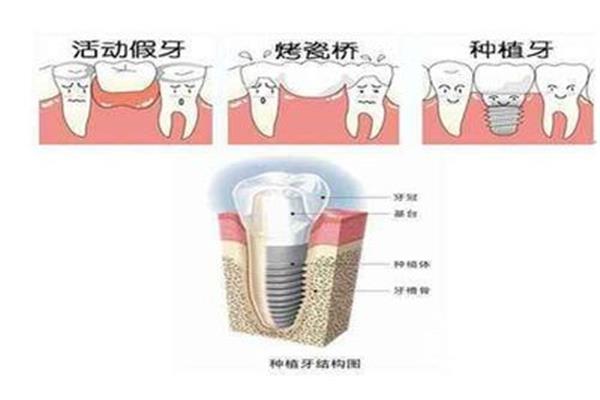 種植牙疼還是拔牙疼?種牙比拔牙更痛苦嗎?