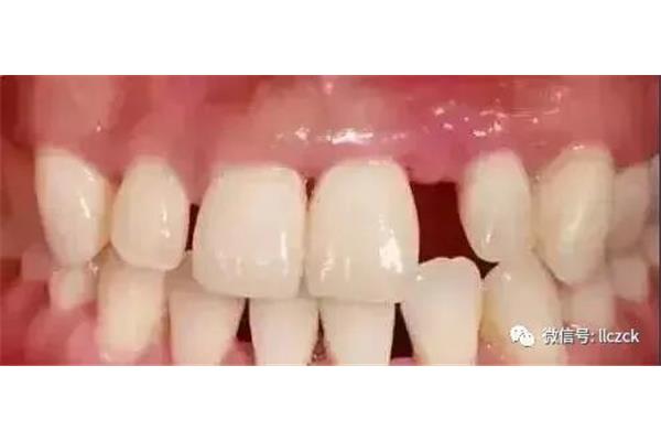 齦下潔治后牙槽骨恢復,拔牙后牙骨恢復需要多長時間?