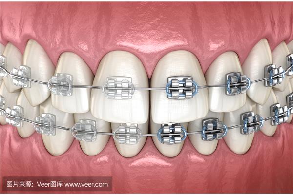 你多久調整一次牙套?你多久調整一次你的鋼牙套?