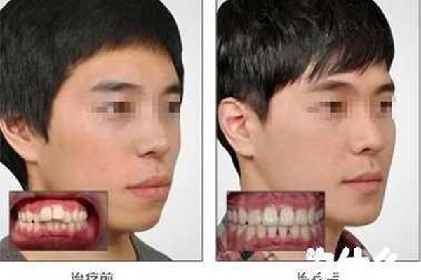 戴鋼牙套多久能看到效果,戴牙套一年后臉型的變化