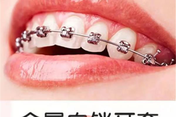 金屬自鎖牙套要戴多久