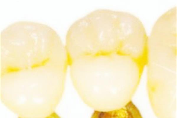 全瓷牙和鑄瓷牙有什么區別?烤瓷牙用什么材料好?
