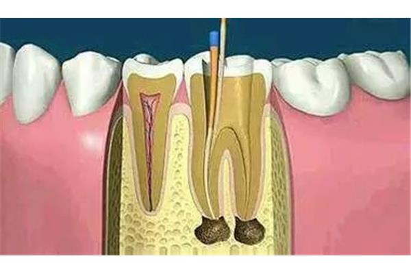 補牙根管治療要多久