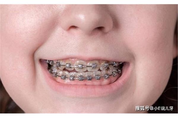 隱形牙套至少要帶多久,正畸的最佳年齡