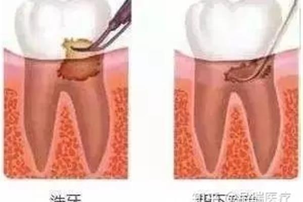 洗牙后牙齦多久能長好