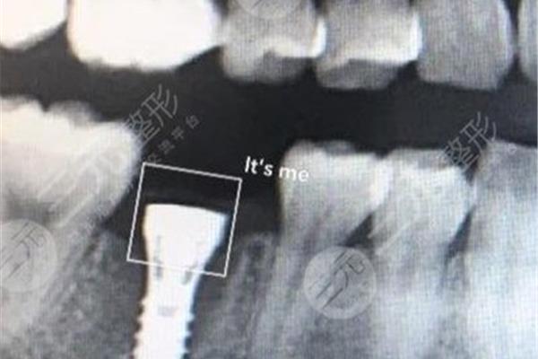 植門牙能堅持幾年,植門牙要多久?