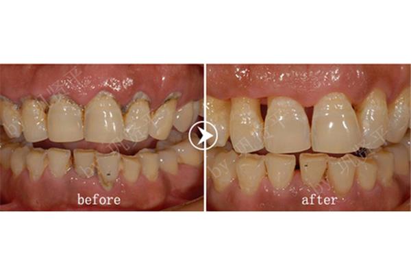 齦下刮治能持續多久?齦下刮治術后多久可以拍片