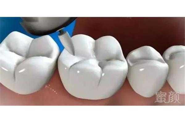 牙科材料能用多久,光固化樹脂補牙能用多久?