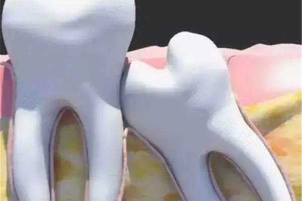 拔牙后牙疼怎么辦?拔智齒后需要多長時間恢復?