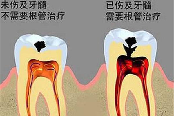 裝假牙需要多長時間,一般持續多久?