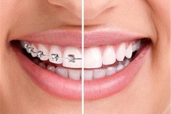 智齒拔完多久可以矯正牙齒,智齒拔完多久可以用牙套矯正?