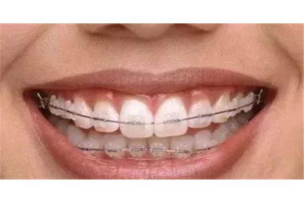 正畸排牙需要多長時間正畸排牙需要多長時間?