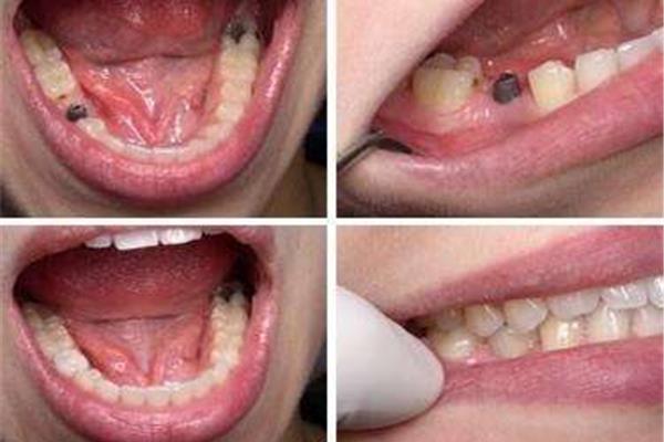 补过的牙可以用多久?一颗牙多久可以补一次?