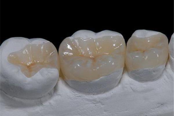 補牙嵌體可以用多久