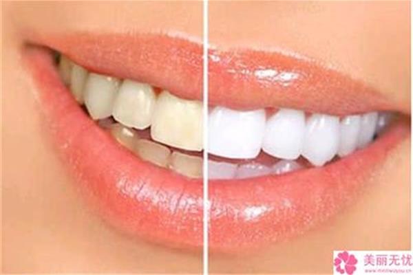 矯正前牙前突需要多長時間,多久能看到效果?