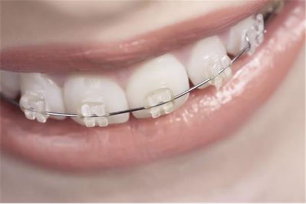 護齒器應該戴多久,護齒器的牙冠可以用多久?