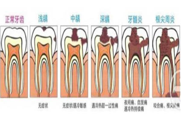 根管治療牙齒發炎要多久才好?