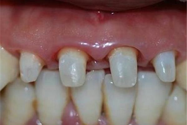 門牙鑲牙能用多久