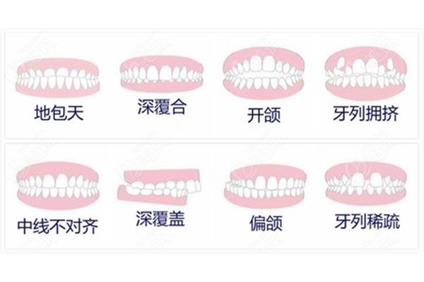 牙齒矯正過程 牙齒矯正皮筋要掛多久