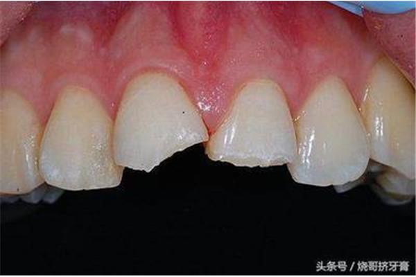 樹脂修復門牙保持多久