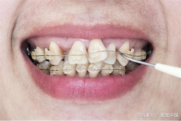 整牙牙套一般要帶多久