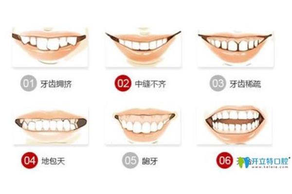 隱形透明牙套有用嗎?隱形牙套和透明牙套有什么區別?