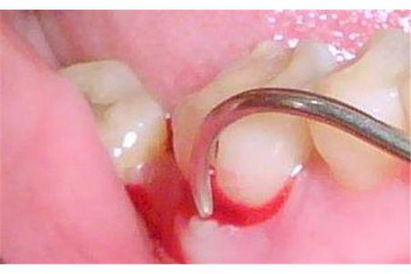 急性牙周炎怎么治療好? 牙周炎急性期多久