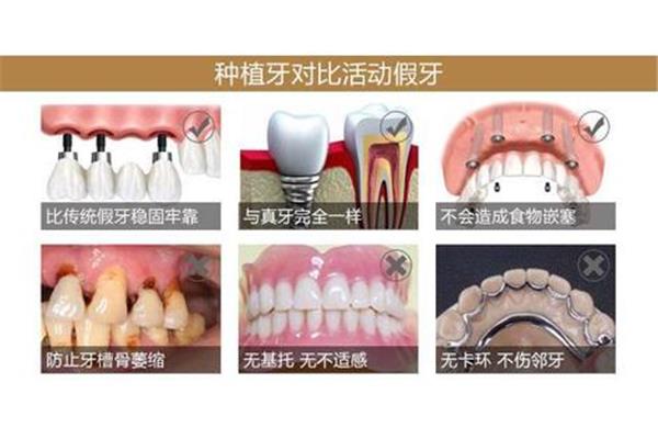 種牙需要花費多長時間? 老人種牙多久恢復
