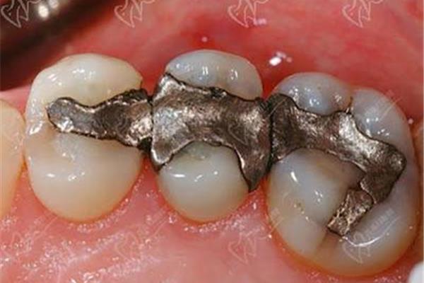 補牙一般能維持多久?專家:和以下幾個因素有關